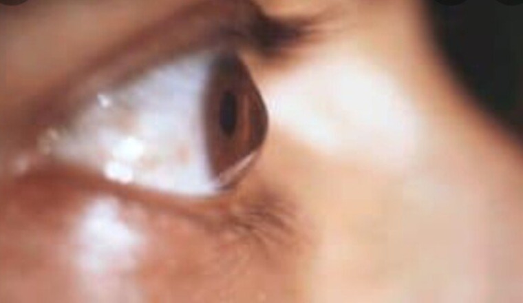 Opération des yeux