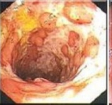 Maladie de Crohn une lueur d'espoir  pour Aziza