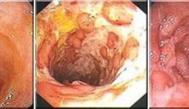 Maladie de Crohn une lueur d'espoir  pour Aziza