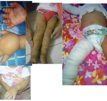 Operation Lymphedema with Love