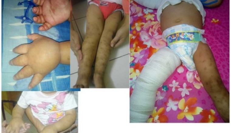Operation Lymphedema with Love
