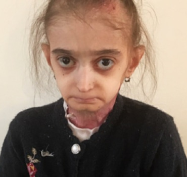 Aidons Lilya atteinte d’une Épidermolyse
