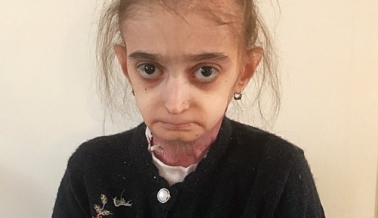 Aidons Lilya atteinte d’une Épidermolyse