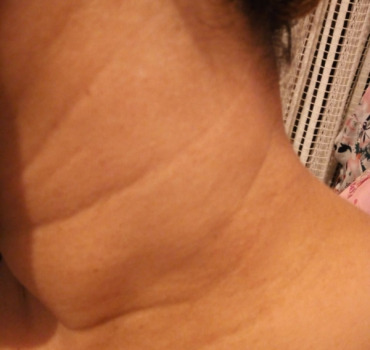 Un espoir pour Naima contre le cancer