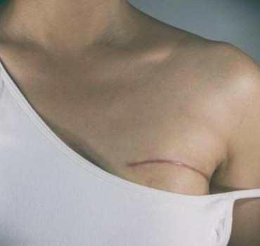 Sauvons Nadia contre le cancer du sein
