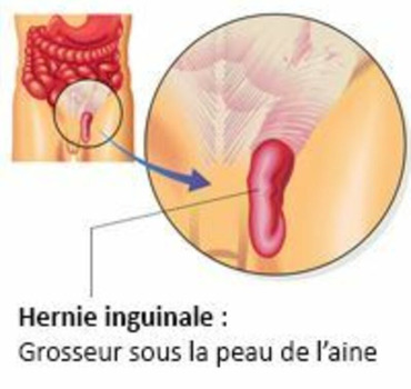 opération pour une hernie inguinale compliquée