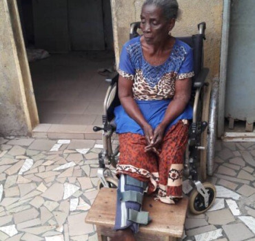 Opération jambe fracturée depuis 4 ans dame 77
