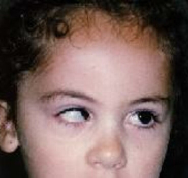 Opération des yeux enfant au Maroc