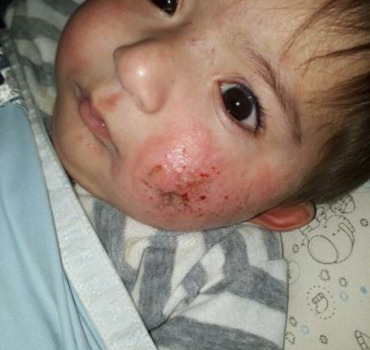 Fente Palatine (Opération Urgence Bébé) - Turquie