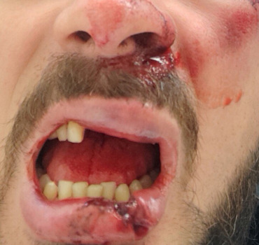 Implant dentaire suite a un accident