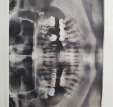 Des implants dentaires pour Caroline