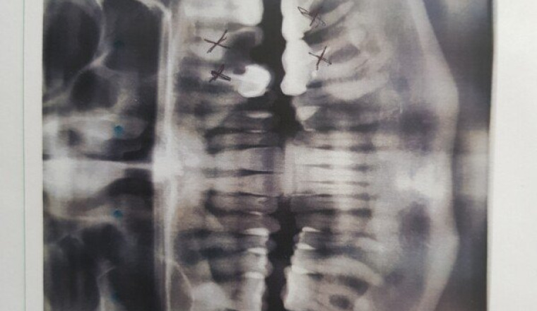 Des implants dentaires pour Caroline