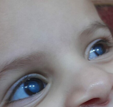 Aide/help Sana's (2.5) eyes/ operations des yeux