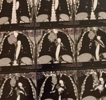 radiothérapie cancer des poumons ( Alger)