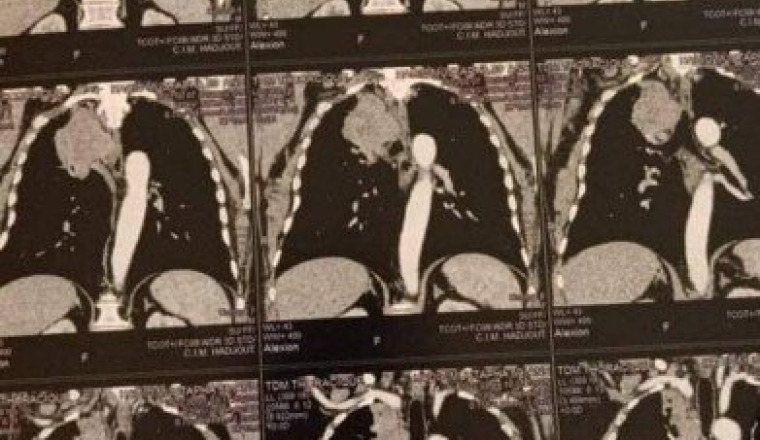 radiothérapie cancer des poumons ( Alger)