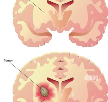 operation  tumeur au cerveau