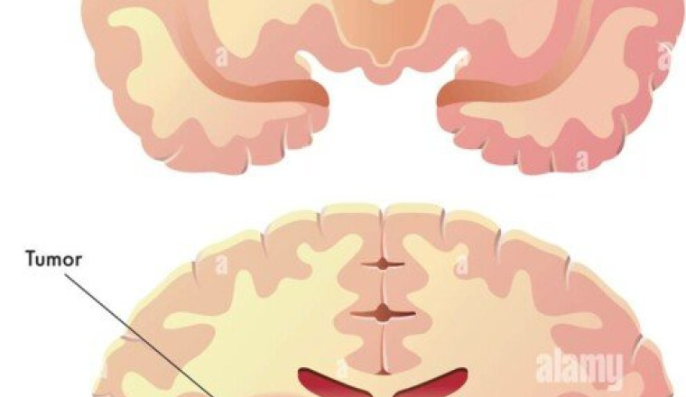 operation  tumeur au cerveau