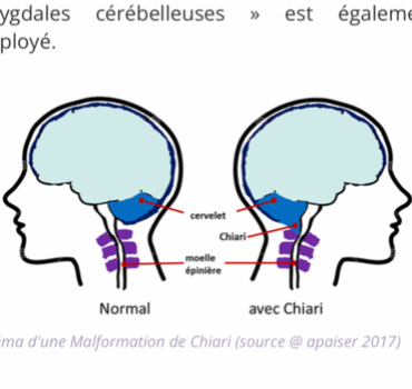 Tous ensemble contre Chiari