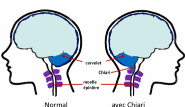 Tous ensemble contre Chiari