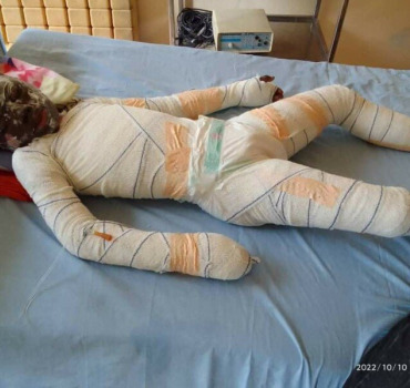 Urgence pour cet enfant brûlé