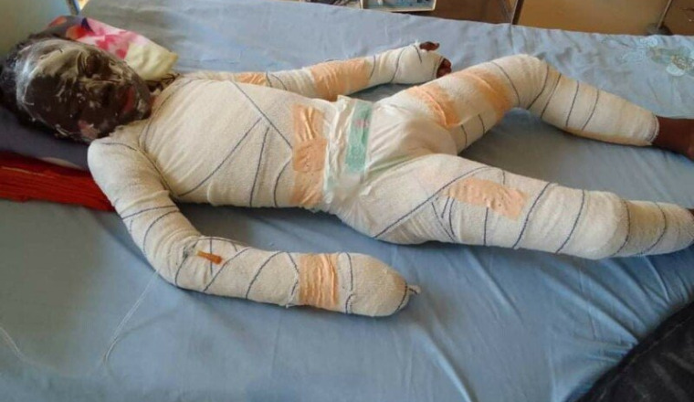 Urgence pour cet enfant brûlé