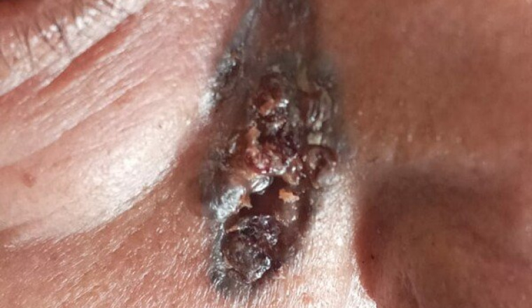 Soins tumeur