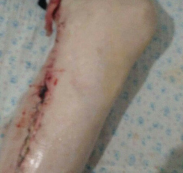 Urgence gangraine  l hôpital refuse l amputation