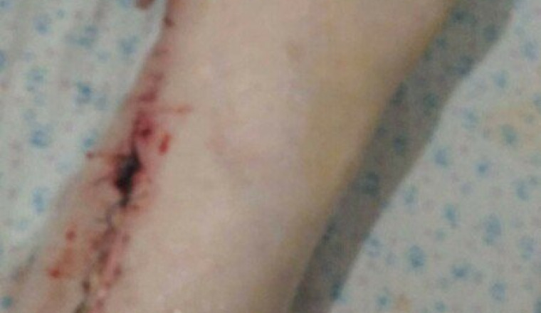 Urgence gangraine  l hôpital refuse l amputation