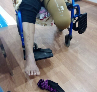 Prothèse orthopédique pour notre tante