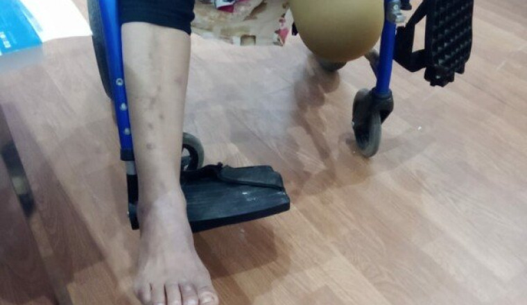 Prothèse orthopédique pour notre tante
