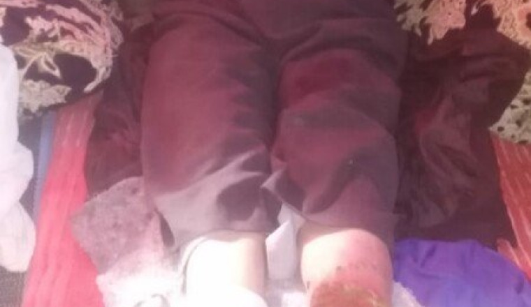 Essayons de sauver la jambe de CHALH LHOU
