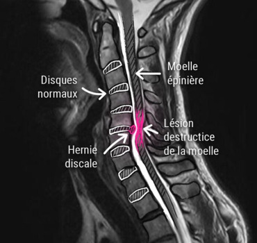 Des prothèses cervicales pour Andy
