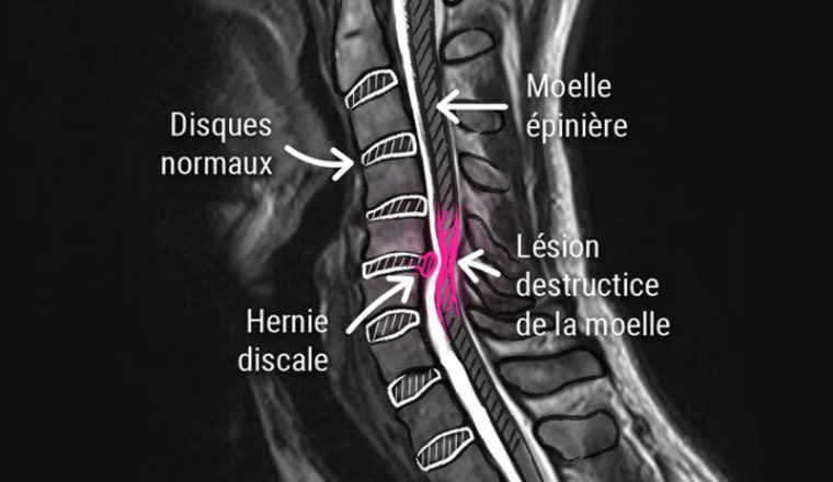 Des prothèses cervicales pour Andy