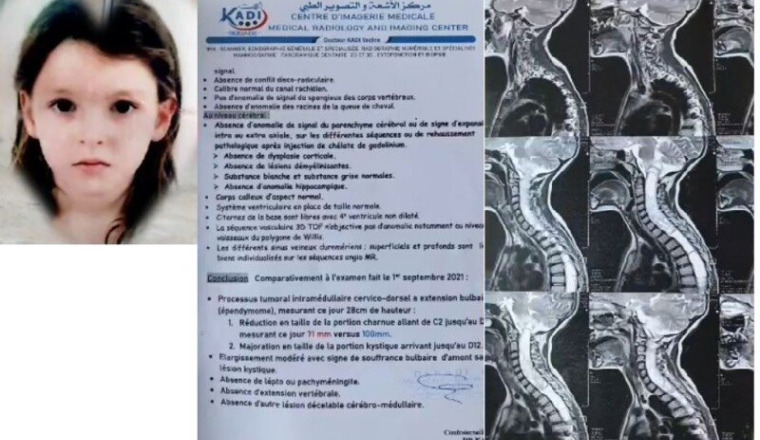 Petite TOUNSSIA atteinte d'une tumeur en Algérie