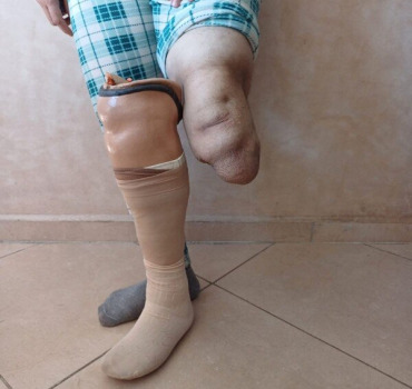 Une nouvelle jambe pour Fatima