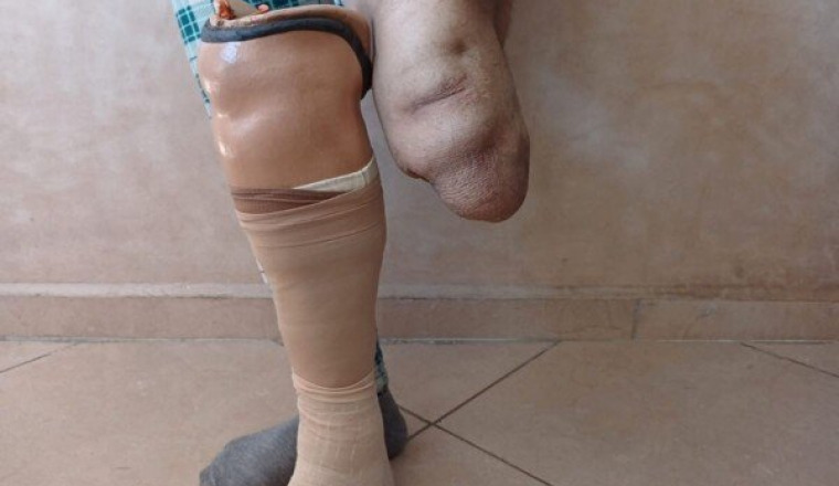 Une nouvelle jambe pour Fatima
