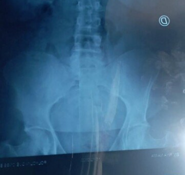 AIDE URGENTE POUR UNE PERSONNE PARALYSÉE