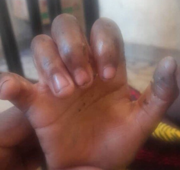 Soins pour Bayi Cissé
