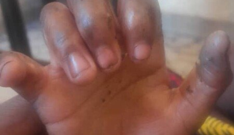 Soins pour Bayi Cissé