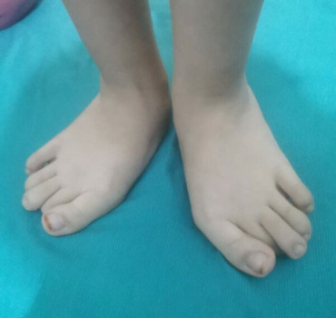 Chaussure orthopédique pour la petite Nour.
