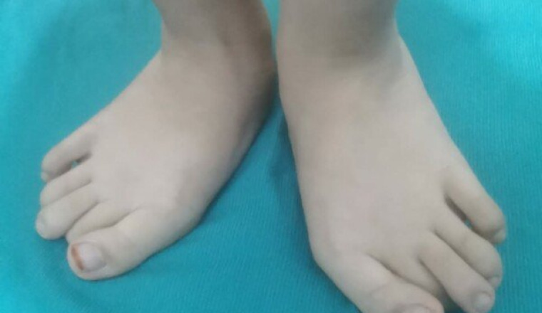 Chaussure orthopédique pour la petite Nour.