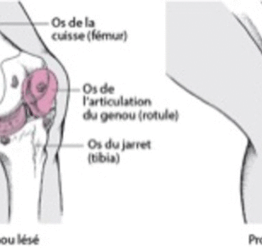 Aide aux Frais de l’opération des prothèses genoux