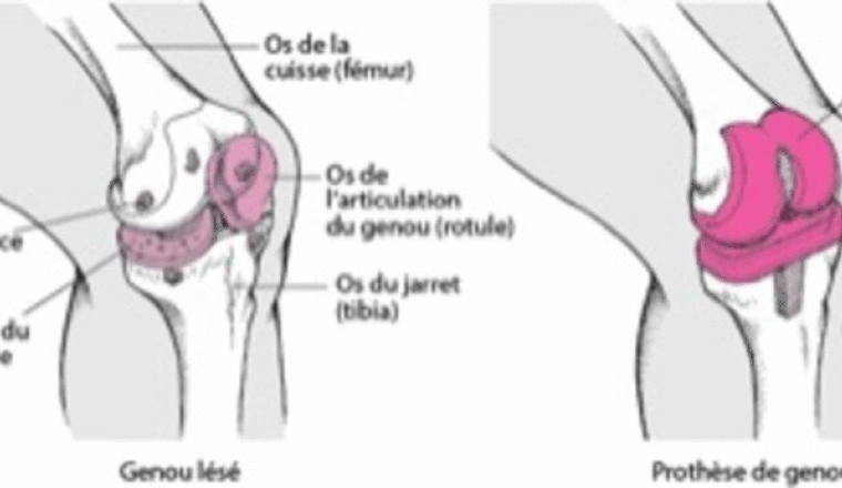 Aide aux Frais de l’opération des prothèses genoux