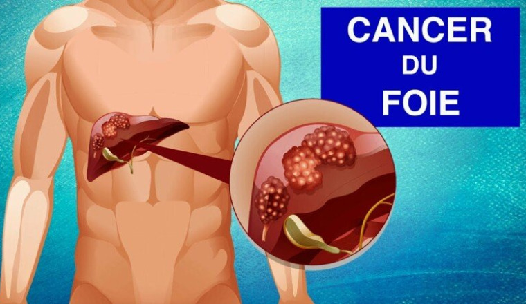 Cancer du Foie aider notre frère MusaMagiraga