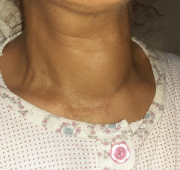 Opération thyroïde pour fatima