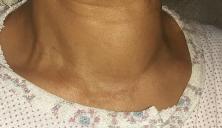 Opération thyroïde pour fatima