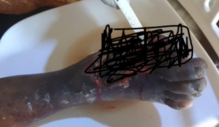 Aidons à amputer le pied de ce père de famille