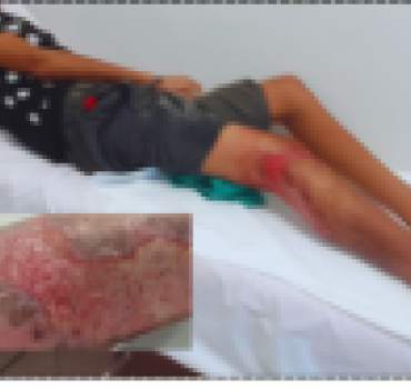 Mohssine 14ans, victime d'un accident de la route