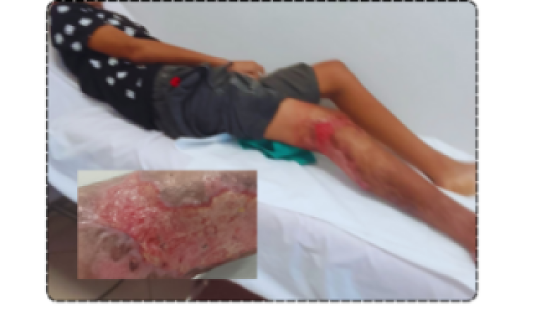 Mohssine 14ans, victime d'un accident de la route