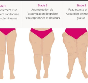 Opération  maladie la lipœdème stade 2